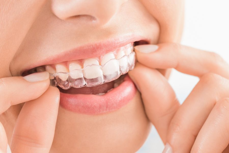 Người đi làm có nên niềng răng không Yenle Dental
